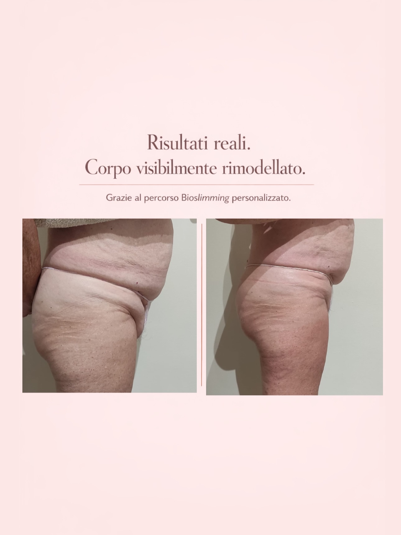 Risultato trattamento 7 – Vanità Estetic